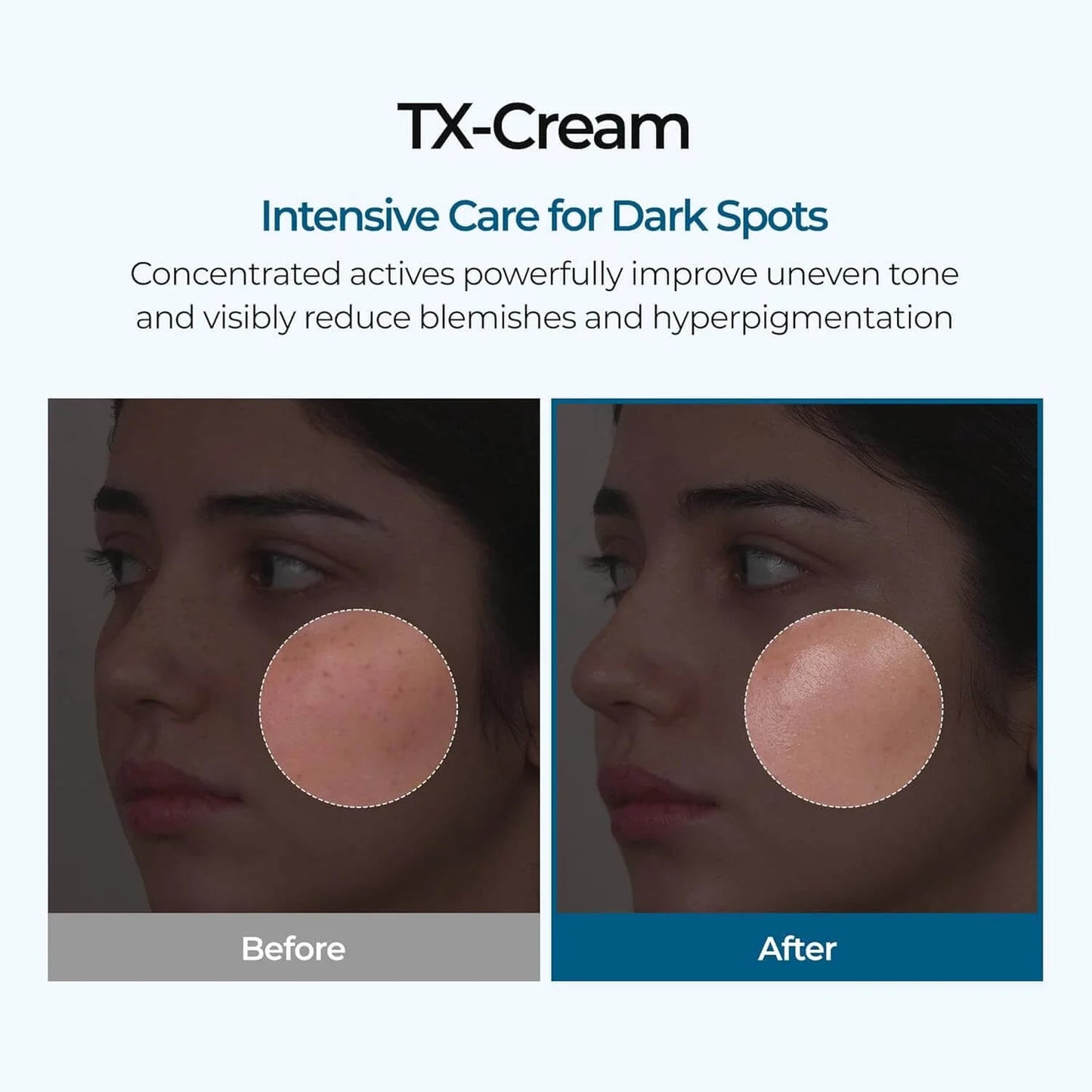 🧴 TX Acid Cream