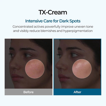 🧴 TX Acid Cream
