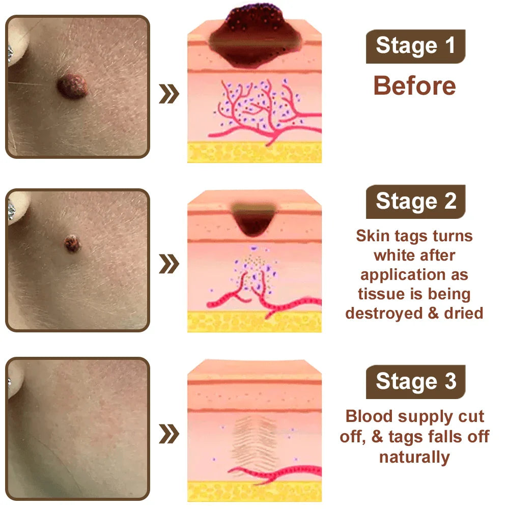 Natravor® Black Rice Skin Repair Essence Cream ⚕️ FDA Certified (Removes warts and skin growths, improves keratin buildup and seborrheic dermatitis, follicular keratosis, age spots, and bruising)