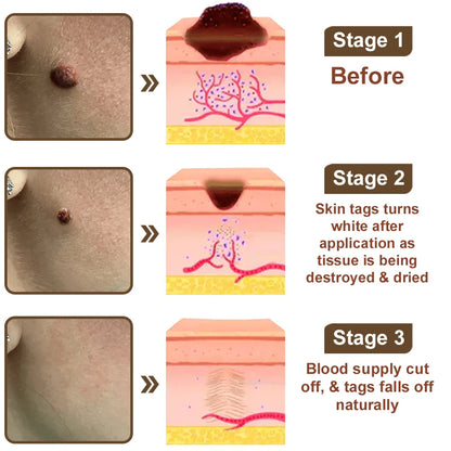 Natravor® Black Rice Skin Repair Essence Cream ⚕️ FDA Certified (Removes warts and skin growths, improves keratin buildup and seborrheic dermatitis, follicular keratosis, age spots, and bruising)